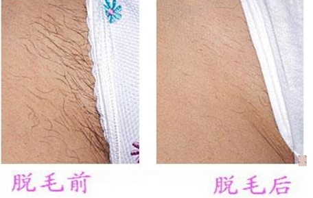 深圳比基尼脱毛吗?