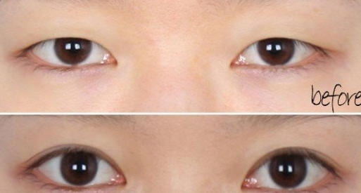 深圳开眼角手术吗?