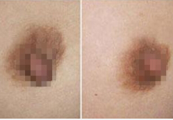 深圳乳头缩小术怎么样?