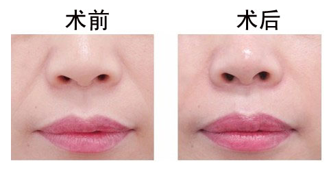 深圳做漂唇要如何选色?
