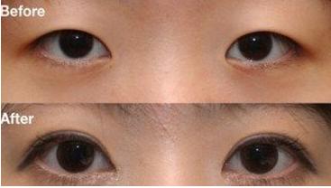 深圳开眼角要注意什么?