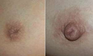 深圳乳头内陷矫正手术疼么?