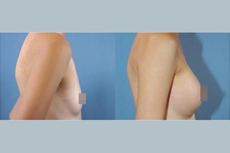深圳什么原因造成乳房下垂?