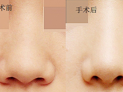 深圳怎样缩小鼻孔?