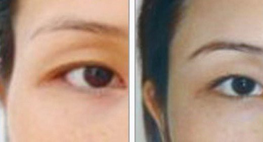 深圳自体脂肪丰太阳穴的价格是多少?