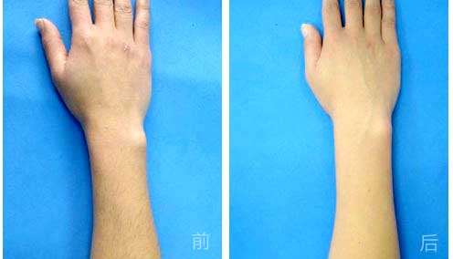 深圳手臂要怎么脱毛?