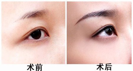 深圳如何将眉弓垫高美化眼部轮廓?