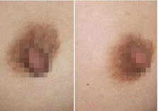 深圳乳晕大要怎么变小?