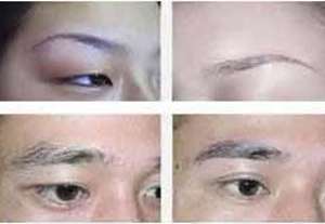 深圳眉弓填充哪家医院好呢?