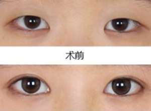 深圳开眼角有没有后遗症?