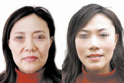 深圳抬头纹手术除皱的方法?